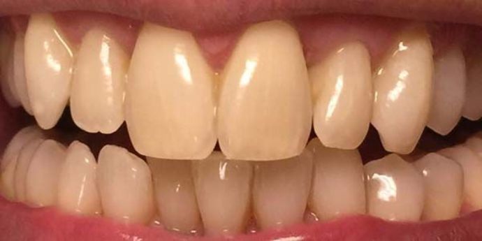 before teeth whitening